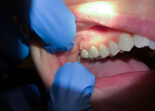 Best Emergency Tooth Extraction  in Ester, AK